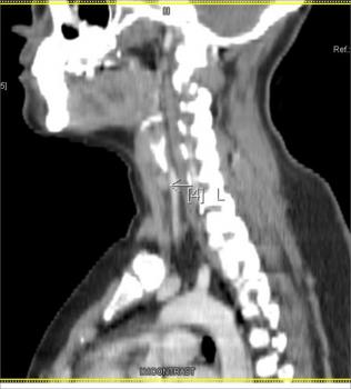 CECT Neck : 2 yrs post surgery sagital post contrast images showing a small 7x5mm enhancing nodule in the