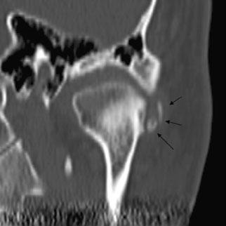 2 Non-contrast CT (axial image) A poorly-delineated mass lesion in contact with the lateral margin of the left mandibulr condyle and well-delineated and maviously-sized