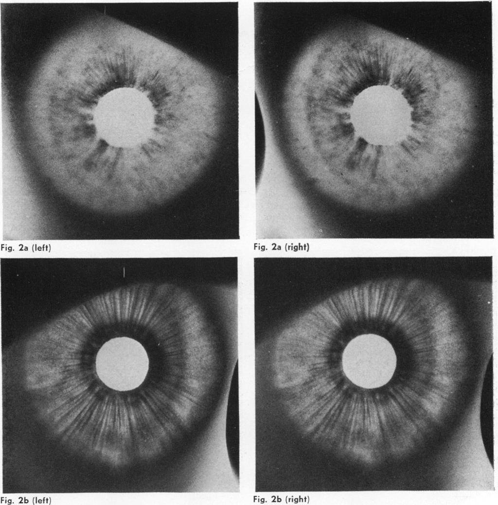 Infra-red transillumination stereophotography of the iris in Fuchs's heterochromic cyclitis appeared in infra-red transillumination stereophotographs as light, even translucence of the iris (Figs.