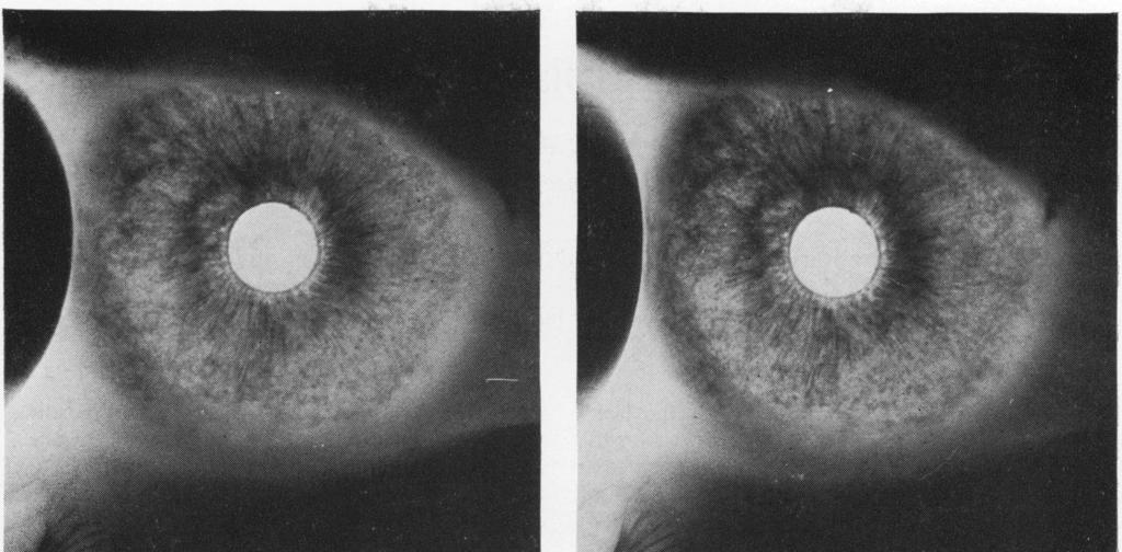 Infra-red transillumination stereophotography of the iris in Fuchs's heterochromic cyclitis Fig. 5 (left) Fig.
