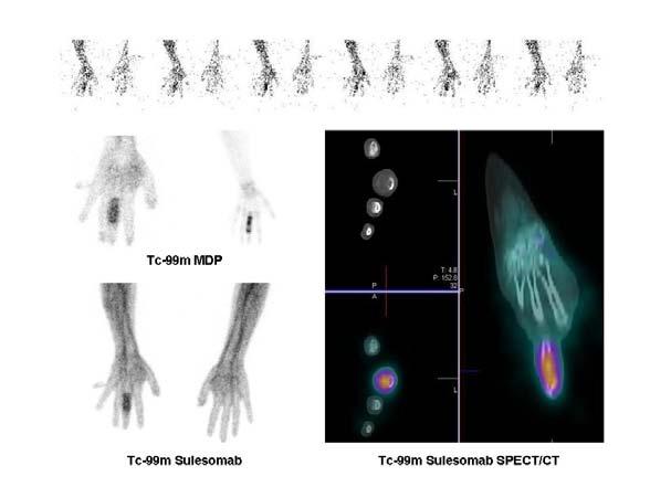 Tc-99m labelled Anti-granulocyte Antibodies Horger et al (2003) showed that SPECT/CT changed the interpretation of radio-immuno-scintigraphy in 28% of suggestive foci evaluated in 27 patients with