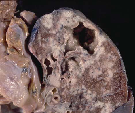 SCPA217 Lung Tuberculosis