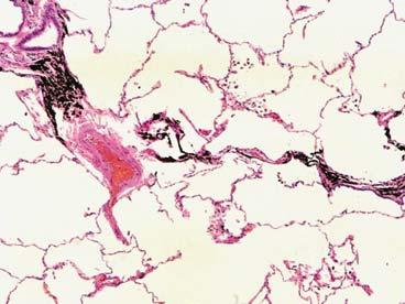 Cyanosis (purple colour of tissues due to low oxygen levels
