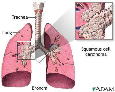 Lung Cancer Lung cancer is a malignant tumor of the lungs. Gross classification into 2 types: 1.