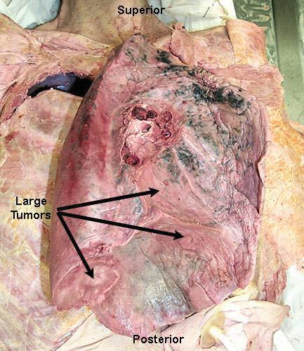 Invasion of pleura and mediastinal lymph node is common.