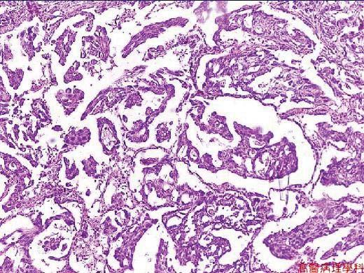 jpg 66 Small cell carcinoma or Oat cell CA It generally starts in one of the larger breathing tubes 15% of lung cancer Grows and spreads