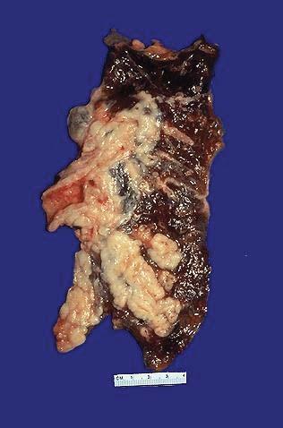 Found mostly in heavy smokers 67 Arising centrally in this lung and spreading extensively is a small cell anaplastic (oat cell) carcinoma.