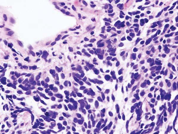 Small cell carcinoma : sheets of cells, cells with scant cytoplasm, molded nuclei (nuclear molding, is conformity of
