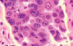 Large cell carcinoma : Tumor cells have