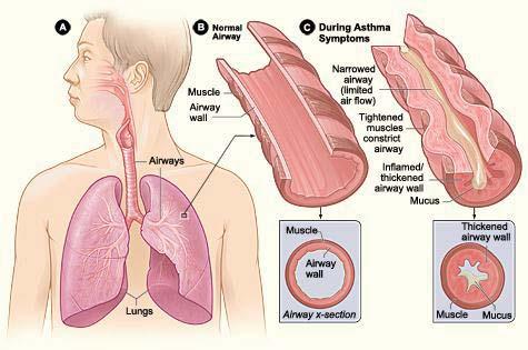 disease of the airways characterized bronchospasm (the tightening of the muscles surrounding the airways) inflammation (the swelling and irritation of