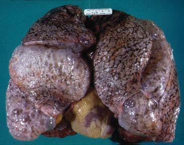 the left lung. Both lungs are markedly enlarged. http://img.