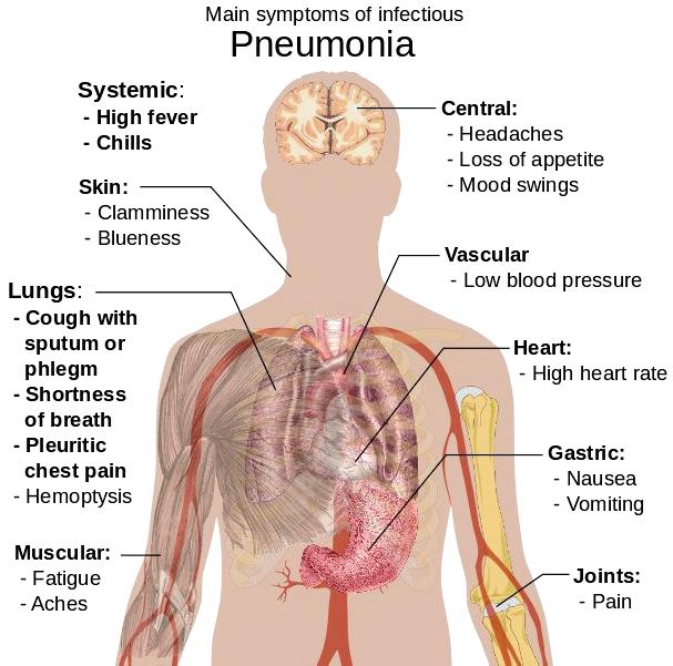 Pneumonia Lobar pneumonia affects a section (lobe) of a lung.