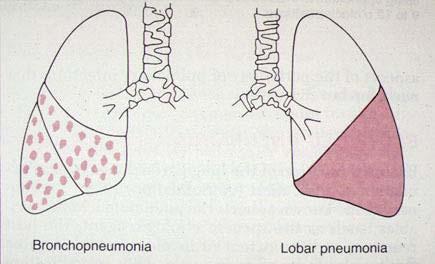 both lungs. http://en.wikipedia.org/wiki/pneumonia 33 http://www.