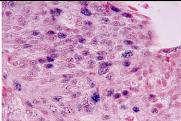 pathologists to confirm diagnosis in poorly differentiated and