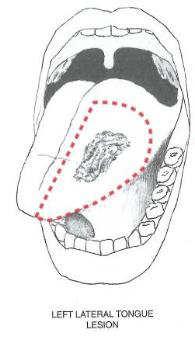 Tongue Cancer Most commonly lateral borders of anterior 2/3 tongue (oral tongue.