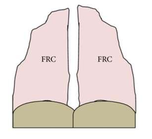 Intrinsic lung pathology reduced FRC