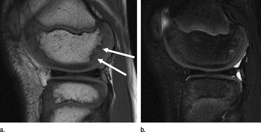 Results Variability in ossification was present in 202 (22.2%; 95% CI: 19.5%, 24.9%) patients (278 condyles). Ossification variability was significantly more common in boys ( n = 153, 33.