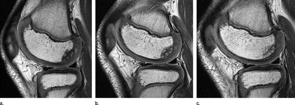 differentiate variability in femoral condyle ossification from osteochondral lesions and bone lesions such as infarcts, especially in patients receiving steroid therapy.