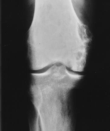 a. b. Figure 1. (a) Anteroposterior radiograph shows a large, lytic lesion of the medial femoral condyle.