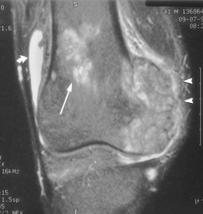 Numerous nodules are outlined by low signal intensity (arrowhead). Edema is present in the suprapatellar soft tissues (arrow).