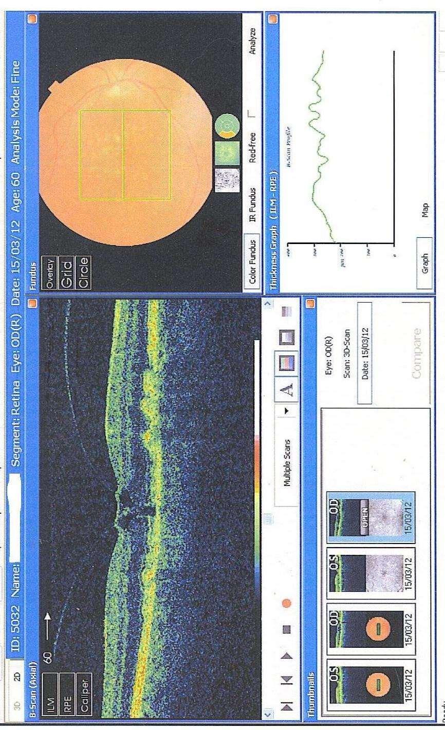 RIGHT EYE OCT 15/3/12 Follow on Advice PVD with retinal traction cause of reduced acuity.