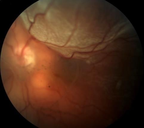 79.59%), proliferative diabetic retinopathy (17 cases - 17.34%) and giant retinal tears (3 cases - 3.06%). 29 eyes (29.59%) were pseudophakic at primary surgery.