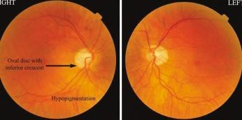 those seen in glaucoma; however, they