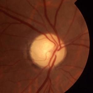 Characteristics often noted when observing the Compressive optic disc include: Acute