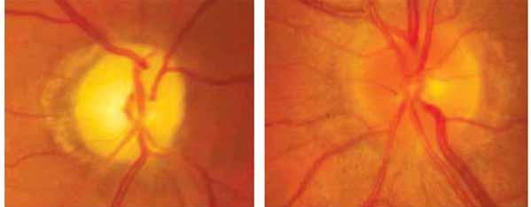 Fundus Examination after 7 months ISCHEMIC OPTIC NEUROPATHY Ischemic optic neuropathy may be confused with glaucoma when the patient is seen in a non-acute