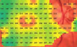 AMD with Macular Hole The RTA 5 can detect early dry