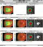 RTA 5 Baseline Report For Detection The RTA 5 Report reveals essential data for early disease detection at the macula and ONH complete with normative comparisons.