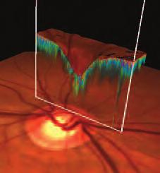 1 2 2D and D Retinal Thickness Maps The RTA 5 empowers diagnostic capability by