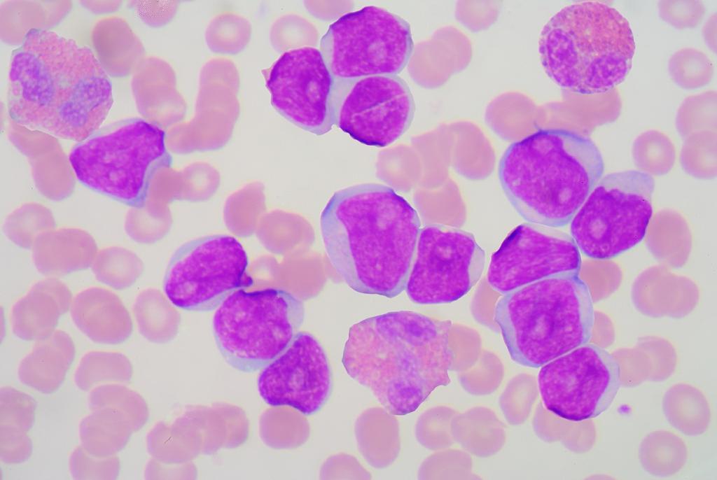Thrombocytopenia Might bleed" vs.