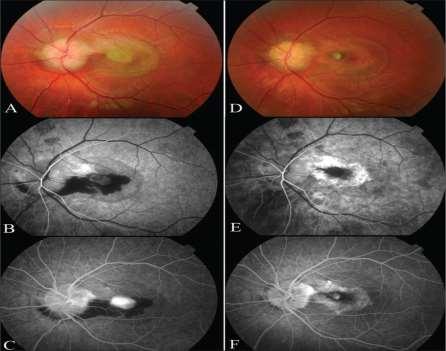 the visual field Fluorescein angiography