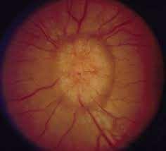 peripapillary cotton-wool spots, Paton s lines macular hard exudates and hemorrhages (macular star ) When the papilloedema becomes chronic, the disc