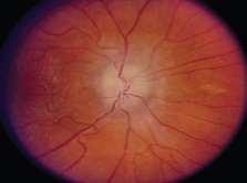 Ophthalmoscopy using the red free filter shows slit