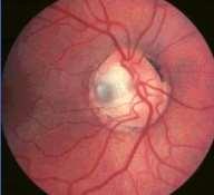 An optic nerve pit is an excavation of the optic nerve head.