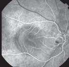 while?? schisis within the retinal layers.