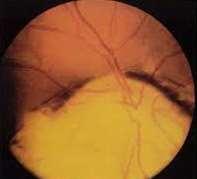 inferior temporal part of the optic disc.