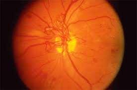 Neovascularization of the disc Optic Atrophy Pappilledema Neovascularization of the disc is defined