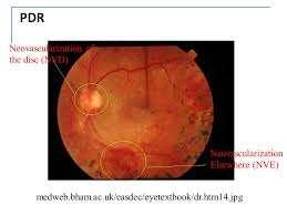 The presence of new vessels on the optic disc is indicative of a more extensive and severe retinal ischemia With rare exceptions, neovascularization of the disc is almost always associated with the