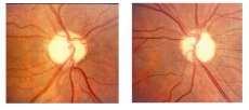 Disc pallor in optic atrophy may be sectorial, wedge shaped or diffuse The genesis of the pallor itself has been attributed to two factors: 1) a reduction in blood supply 2) formation of glial tissue.