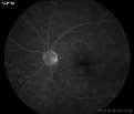 presence of retinal arteriolar narrowing and sheathing of retinal