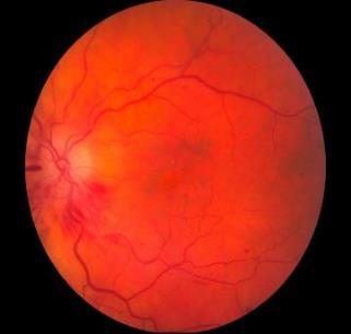 CRVO- Non-ischemic classification } may present with good vision } few retinal hemorrhages } Few or no