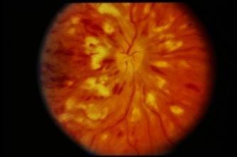 CRVO-Ischemic classification } severe visual loss 20/400 or worse } extensive retinal hemorrhages & cotton-wool spots } Positive APD