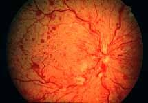 Ischemic Central Retinal Vein Occlusion } confluent retinal hemorrhages, flame shaped }