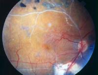 Branch Retinal Vein Occlusion-BRVO } collaterals develop as
