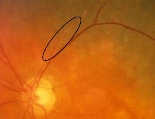 BRVO- characteristics retinal hemorrhages and venous tortuousity } gradually decrease 6- to 12-month