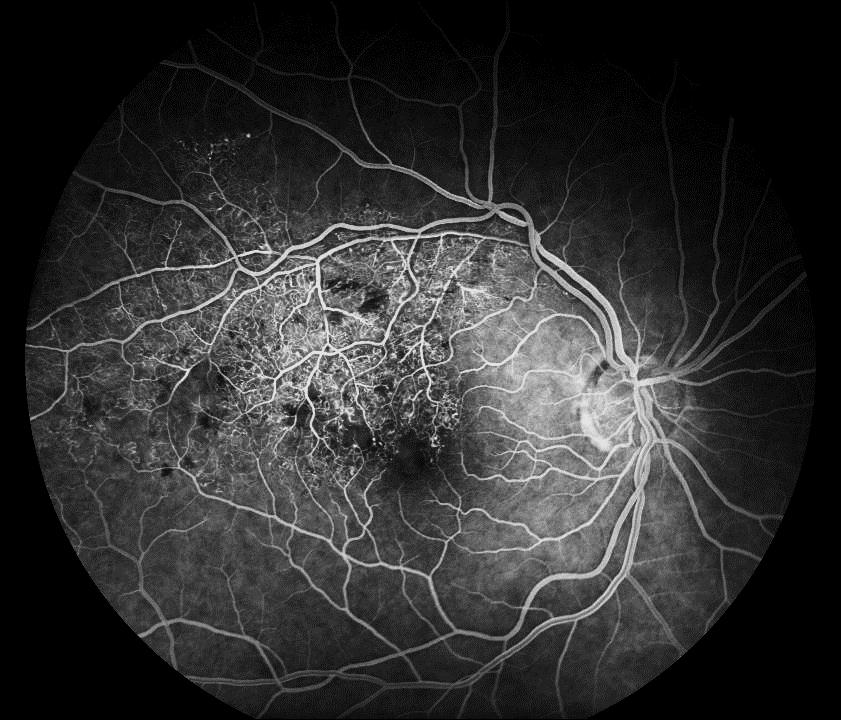 BRVO- Treatment from BVOS sectoral PRP* to prevent the retinal neovascularization } reduced