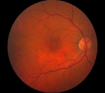 Macular Branch Retinal Vein Occlusion } small venous tributary } subgroup of BRVO }
